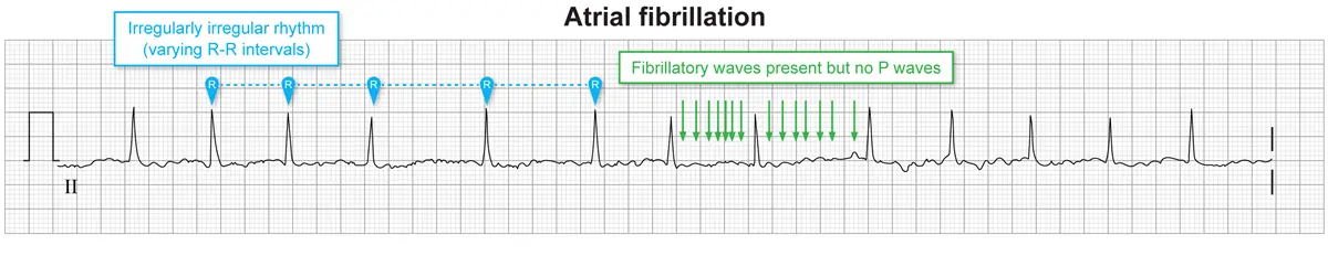 An ECG rhythm strip labeled "Atrial fibrillation" showing an irregularly irregular rhythm with variable spacing between QRS complexes. At the top left, a light blue box with the text "Irregularly irregular rhythm (varying R-R intervals)" points with dashed lines and blue markers labeled "R" to several R wave peaks. In the middle section, a green box stating "Fibrillatory waves present but no P waves" points via multiple green downward arrows to fine, irregular fibrillatory baseline fluctuations occurring between narrow QRS complexes without distinct P waves.