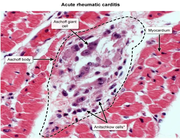 Microscopic view of an Aschoff body in acute rheumatic carditis showing central fibrinoid necrosis surrounded by inflammatory cells, including multinucleated Aschoff giant cells and Anitschkow cells with owl-eye chromatin patterns set within cardiac muscle fibers