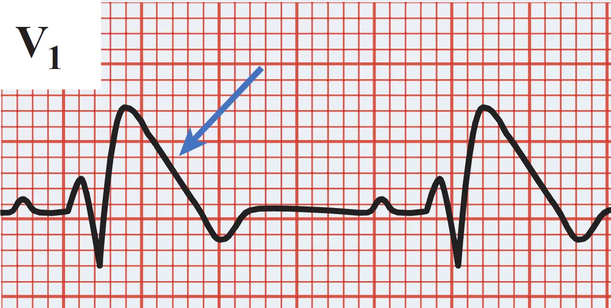 An ECG tracing from lead V1 on red grid paper displaying a Type 1 Brugada syndrome pattern. The tracing shows two cardiac cycles, each featuring a P wave followed by a prominent rSR′ pattern with coved ST-segment elevation that slopes downward directly into an inverted T wave. A blue arrow points to the characteristic elevated, coved ST segment descending from the R′ wave.