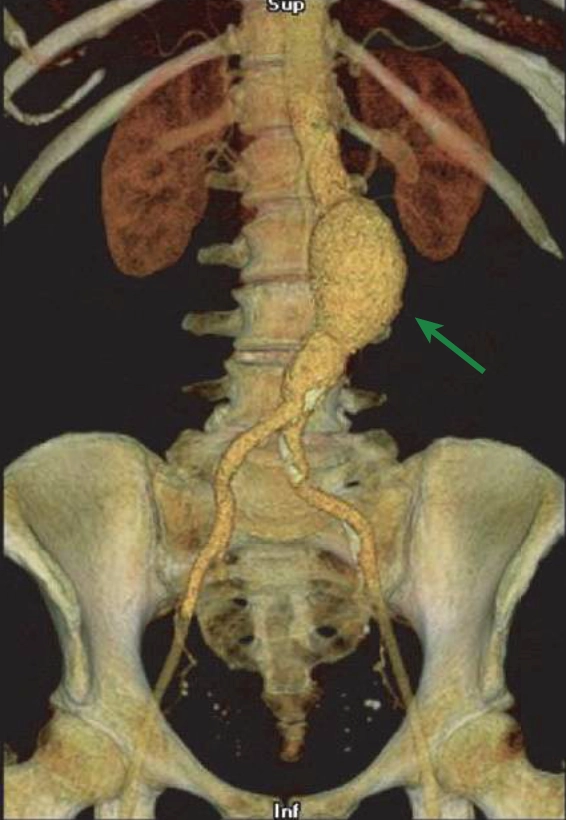 A 3D volume-rendered CT angiography image displaying an infrarenal abdominal aortic aneurysm. The image shows a full anterior view of the abdominal aorta and iliac vessels overlaid against the skeletal anatomy of the lumbar spine and pelvis, with both kidneys visible above. A green arrow points to a prominent, bulbous fusiform enlargement of the infrarenal segment of the abdominal aorta situated just below the renal arteries and above the aortic bifurcation.