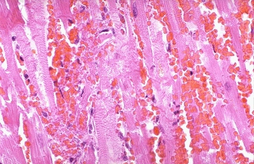 Histological section of an acute myocardial infarction showing loss of cross-striations, absent nuclei, and extensive hemorrhage at the hyperemic border.