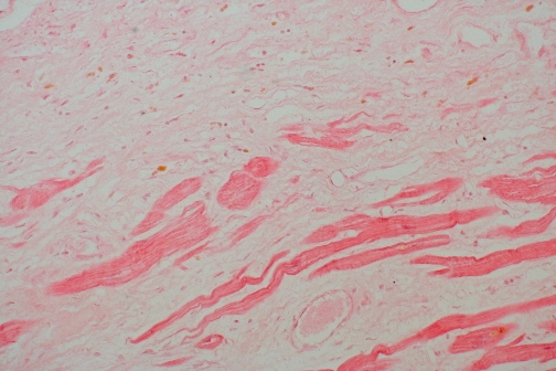 Histological slide of a healed remote myocardial infarction showing dense collagenous scar tissue with residual cardiac muscle fibers.