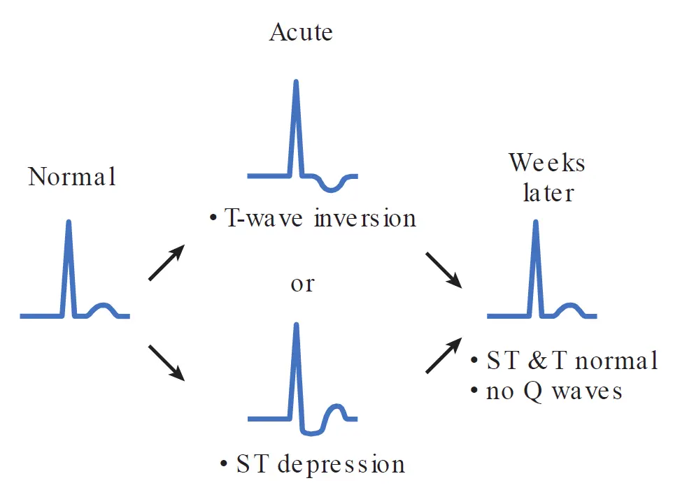 ECG diagram showing non-ST-elevation myocardial infarction (NSTEMI) changes, progressing from acute ST-segment depression or T-wave inversion to recovery without Q waves.