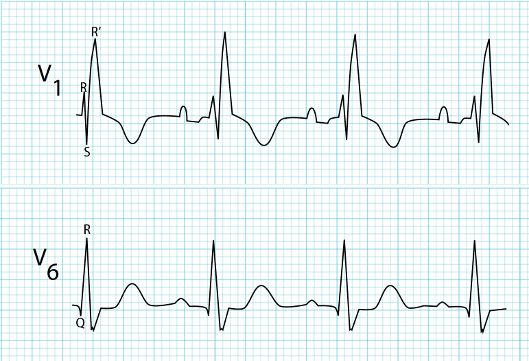 An ECG rhythm strip displaying chest leads V1 and V6 characteristic of a Right Bundle Branch Block (RBBB). Top strip (Lead V1): Shows wide QRS complexes with a classic rsR' (bunny ear) morphology, featuring a small initial R wave, a shallow S wave, a prominent tall secondary R' peak, and T-wave inversion. Bottom strip (Lead V6): Shows wide QRS complexes with a qR pattern featuring a prominent initial R wave followed by a slurred, wide S wave and an upright T wave.