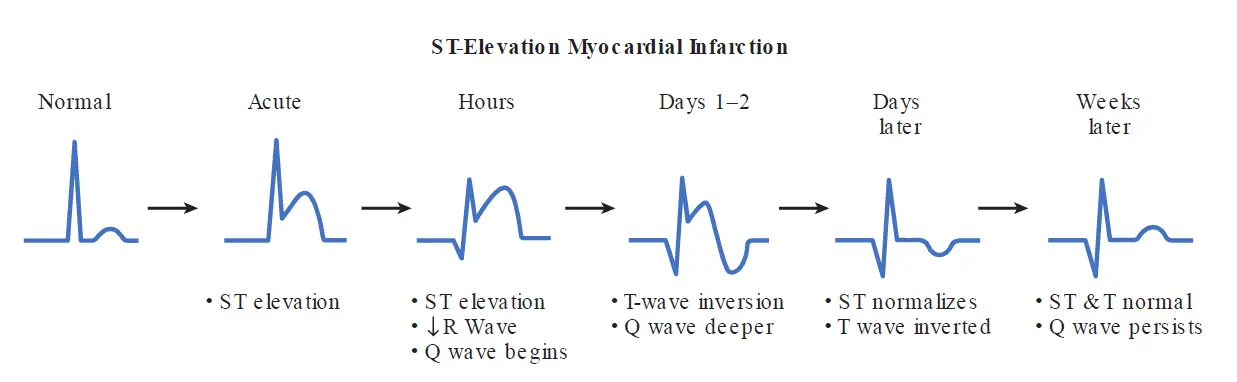 ECG diagram showing the temporal progression of ST-elevation myocardial infarction (STEMI) from acute ST elevation through Q-wave development and long-term resolution.