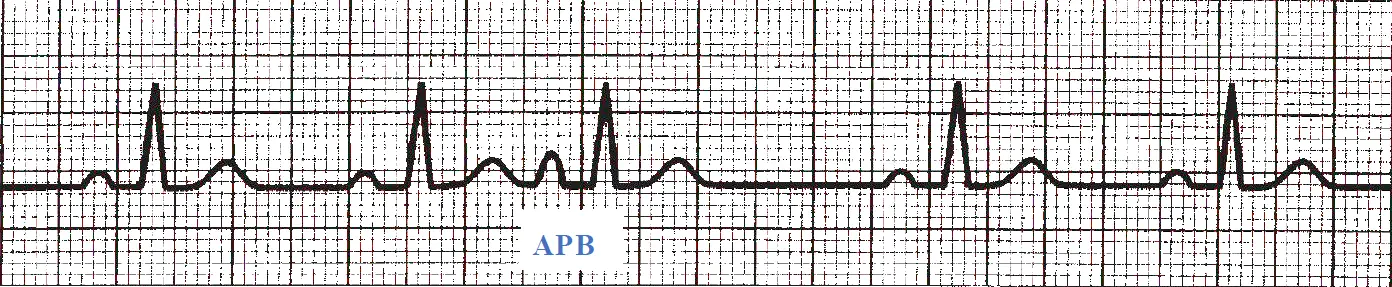 An ECG rhythm strip on standard grid paper displaying an atrial premature beat (APB). The trace begins with two normal sinus beats showing typical P waves, narrow QRS complexes, and T waves. The third cardiac cycle occurs prematurely, marked below with a blue label "APB", featuring an abnormally shaped P wave that merges into the preceding T wave, followed by a narrow QRS complex. A prolonged non-compensatory sinus pause follows the APB before the regular sinus rhythm resumes with two final normal beats on the right.