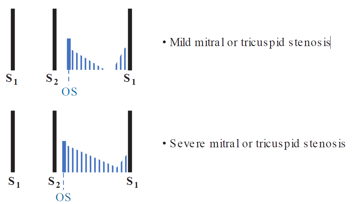A phonocardiogram diagram comparing heart sound murmurs in mild versus severe atrioventricular (mitral or tricuspid) valve stenosis. The top illustration shows mild stenosis, featuring standard S1 and S2 heart sounds, an Opening Snap (OS) positioned further from S2, a short decrescendo diastolic rumble, and a presystolic accentuation phase before the next S1. The bottom illustration shows severe stenosis, demonstrating an Opening Snap (OS) shifted closer to S2 and a prolonged decrescendo diastolic murmur that spans the entire diastolic interval up to the following S1.