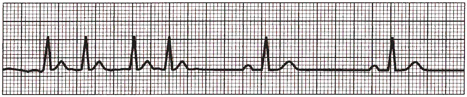 An ECG rhythm strip on standard grid paper displaying bradycardia-tachycardia syndrome. The tracing starts on the left with a run of four rapid, closely spaced cardiac cycles (tachycardia phase), each showing a P wave, narrow QRS complex, and T wave. This episode abruptly terminates into a prolonged flat baseline pause, followed by two widely spaced cardiac cycles on the right side of the strip (bradycardia phase) separated by long isoelectric intervals.