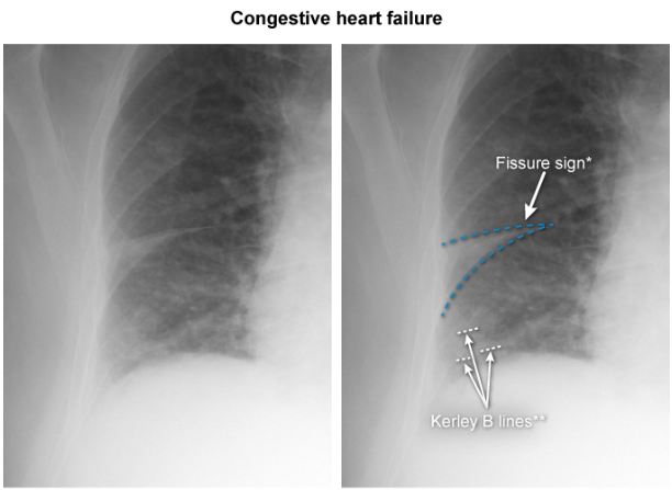 A two-panel chest radiograph demonstrating pulmonary edema from congestive heart failure. The left panel shows an unannotated right lung field. The right panel includes blue dashed annotations highlighting a "Fissure sign" (fluid accumulation along the minor fissure) and white dashed annotations pointing to horizontal Kerley B lines at the lung base, indicating fluid in the interlobular septa.