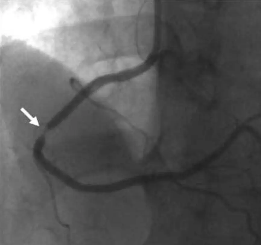 Black-and-white coronary angiogram image showing a coronary artery with a white arrow pointing to a distinct focal segment of luminal narrowing (stenosis).