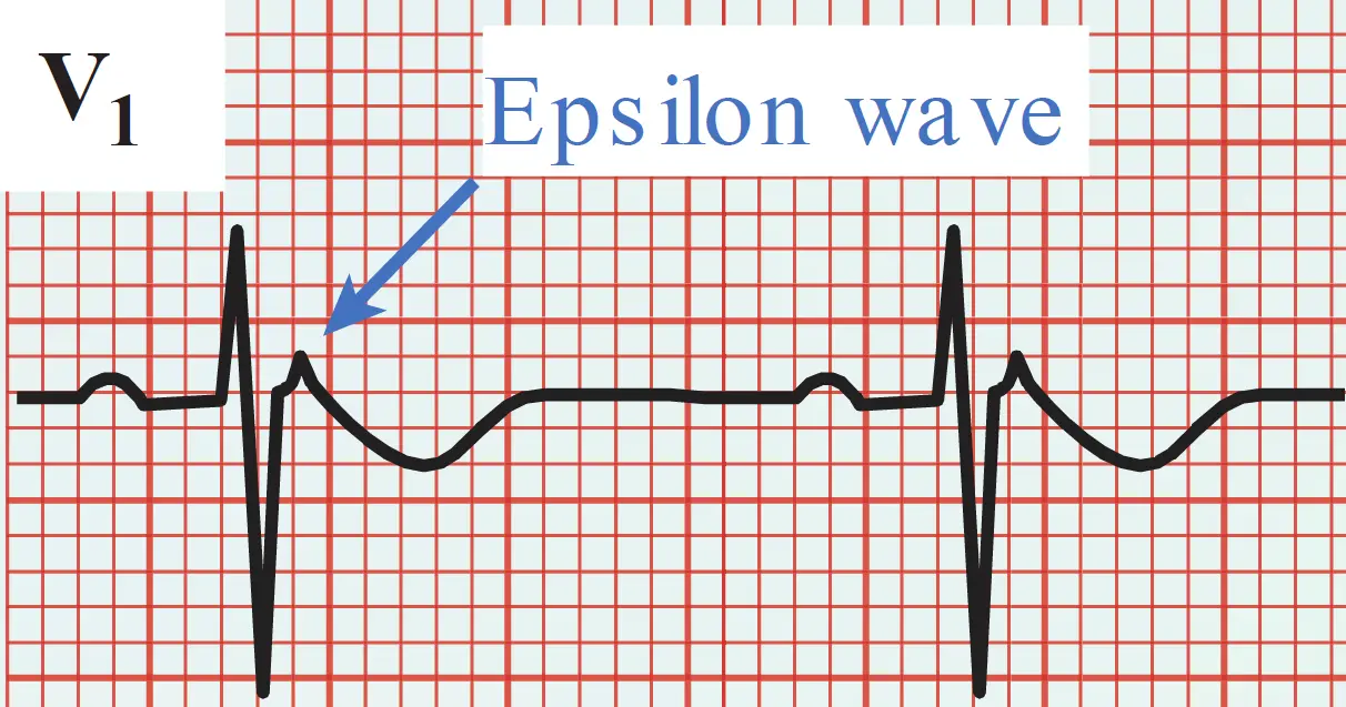An ECG rhythm strip from lead V1 on red grid paper displaying an Epsilon wave, characteristic of arrhythmogenic right ventricular cardiomyopathy (ARVC). The tracing shows two cardiac cycles, each featuring a P wave, a tall R wave, a deep S wave, and an inverted T wave. A blue arrow labeled "Epsilon wave" points directly to a distinct, small notch or deflection occurring on the baseline immediately following the QRS complex and before the start of the T wave.
