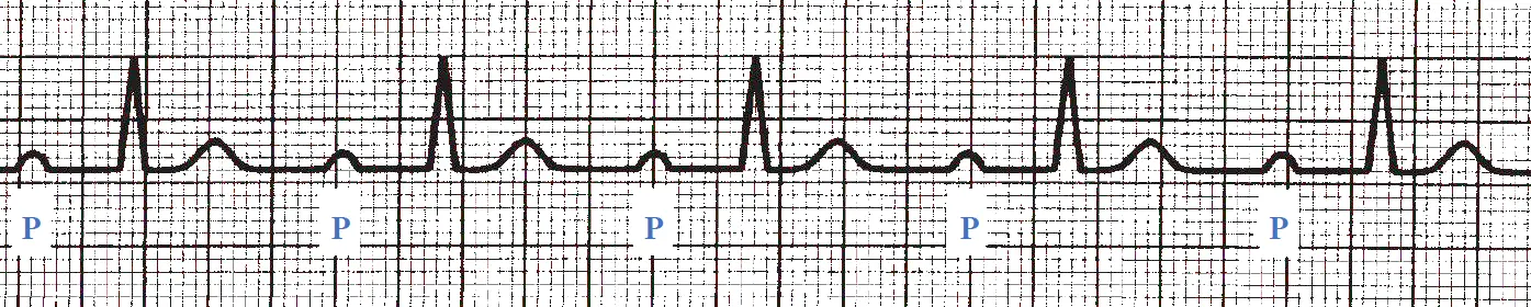 An ECG rhythm strip on standard grid paper displaying first-degree AV block. The tracing shows five consecutive cardiac cycles with a regular rhythm. Each P wave is clearly labeled below with a blue letter "P" and is consistently followed by a normal, narrow QRS complex and a T wave, but with a characteristically prolonged and uniform PR interval preceding each QRS complex.