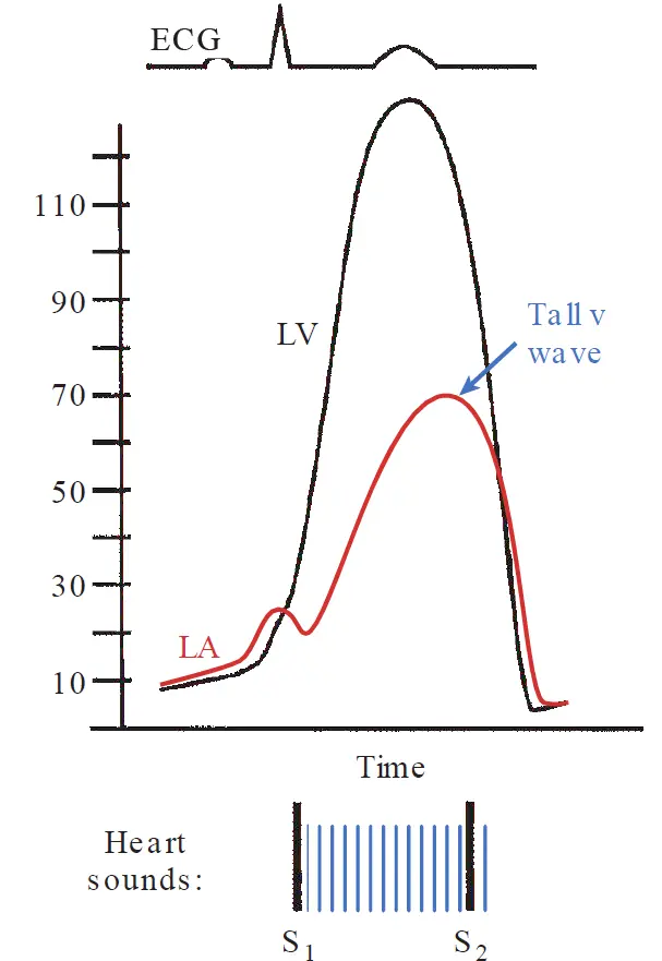 Simultaneous left atrial and left ventricular pressure wave tracings showing a high-amplitude prominent v wave during systole due to mitral regurgitation, paired with an ECG and a phonocardiogram depicting a high-frequency holosystolic murmur