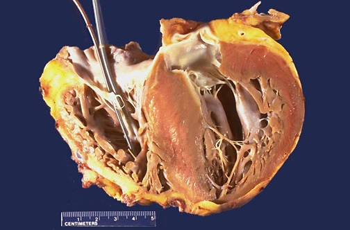 A gross pathological cross-section of a heart displaying severe hypertrophic cardiomyopathy. The specimen shows massive left ventricular muscle hypertrophy with asymmetric, prominent bulging of the interventricular septum into the left ventricular cavity, severely narrowing the chamber lumen. A measurement ruler is visible at the bottom