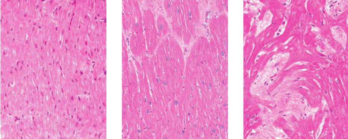 A side-by-side microscopic histology comparison of three cardiac tissue samples stained with hematoxylin and eosin (H&E):Left panel: Normal myocardium showing orderly, parallel cardiac myofibers.  Middle panel: Concentric hypertrophy from hypertension showing uniformly enlarged, organized muscle fibers.  Right panel: Hypertrophic cardiomyopathy showing characteristic severe myocyte disarray with chaotic, disorganized myofiber branching and prominent interstitial fibrosis.