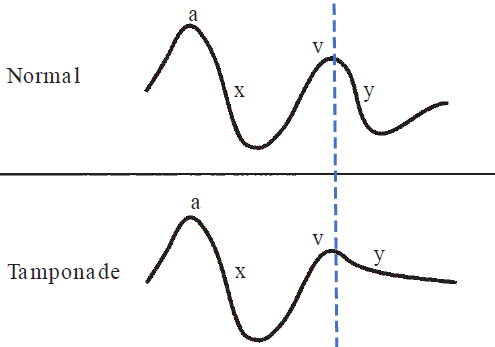 A diagram comparing right atrial pressure and jugular venous pulse waveforms between a Normal state and Cardiac Tamponade. The top curve shows a Normal waveform with distinct labeled peaks and troughs: an "a" wave, "x" descent, "v" wave, and a steep downward "y" descent following the "v" wave peak marked by a vertical blue dashed line. The bottom curve shows a Tamponade waveform, highlighting a preserved "x" descent but a noticeably blunted, flattened "y" descent following the "v" wave, illustrating impaired early diastolic filling of the right ventricle due to external pericardial compression.