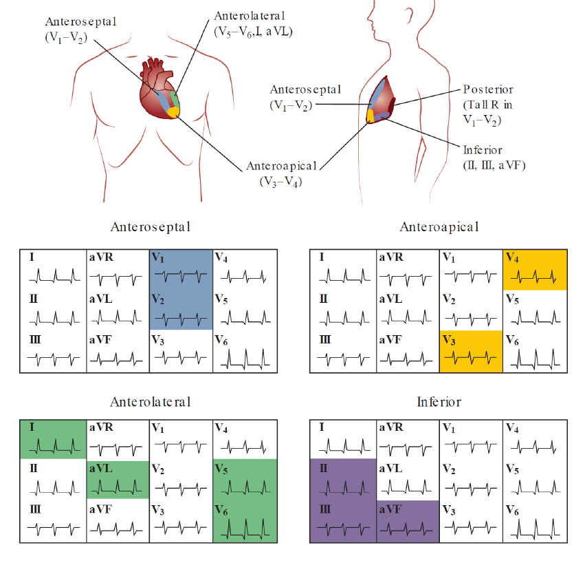 A diagram illustrating anatomical regions of the heart and their corresponding lead groupings on a standard 12-lead ECG layout. Top panel: Anterior and lateral torso diagrams mapping five myocardial territories—Anteroseptal (V1–V2), Anteroapical (V3–V4), Anterolateral (V5–V6, I, aVL), Inferior (II, III, aVF), and Posterior (Tall R in V1–V2). Bottom panel: Four 12-lead ECG grids highlighting specific lead combinations for each region: Anteroseptal highlights V1 and V2 in blue; Anteroapical highlights V3 and V4 in yellow; Anterolateral highlights leads I, aVL, V5, and V6 in green; and Inferior highlights leads II, III, and aVF in purple.