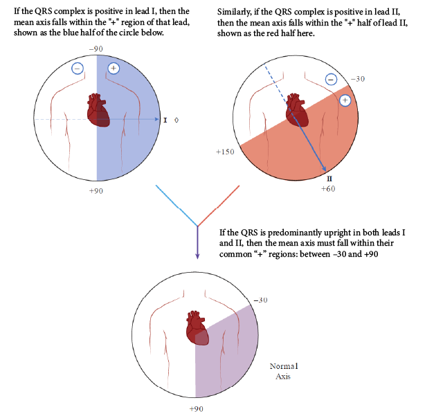 A three-circle diagram illustrating how to determine a normal mean electrical axis using leads I and II. Top-left circle: Shows that a positive QRS complex in Lead I places the mean axis in the positive (blue-shaded) right-half region between -90° and +90°. Top-right circle: Shows that a positive QRS complex in Lead II places the mean axis in the positive (red-shaded) lower-right region between -30° and +150°. Bottom circle: Combines the overlap of both positive regions to show that a predominantly upright QRS in both leads I and II indicates a Normal Axis between -30° and +90° (purple-shaded region).