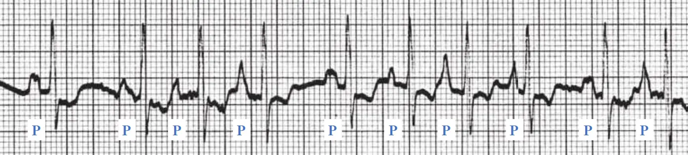 An ECG rhythm strip on standard grid paper displaying multifocal atrial tachycardia (MAT). The tracing shows a rapid, irregular rhythm with ten cardiac cycles, where each P wave is marked below with a blue letter "P". The P waves demonstrate distinct variations in shape, amplitude, and PR intervals (showing at least 3 different P-wave morphologies), with each followed by a narrow QRS complex.