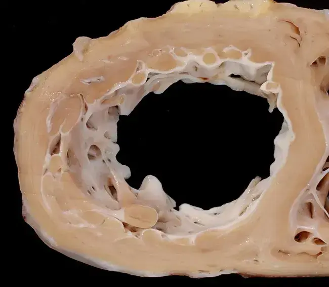 A gross anatomical cross-section of a heart with left ventricular noncompaction (LVNC) cardiomyopathy, showing a spongy, arrest-in-development appearance with abnormally deep intertrabecular recesses and excessively prominent muscular trabeculations extending into the thickened ventricular cavity.
