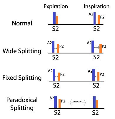 A physiological diagram contrasting normal and pathological variations of second heart sound (S2) splitting during expiration and inspiration. Vertical bars represent the aortic component (A2, blue) and pulmonic component (P2, orange). The four comparative scenarios show: Normal physiological splitting (fused on expiration, split on inspiration); Wide splitting (split during both, widening on inspiration); Fixed splitting (equally split during both expiration and inspiration); and Paradoxical splitting (split on expiration and fused on inspiration, noted as reversed).