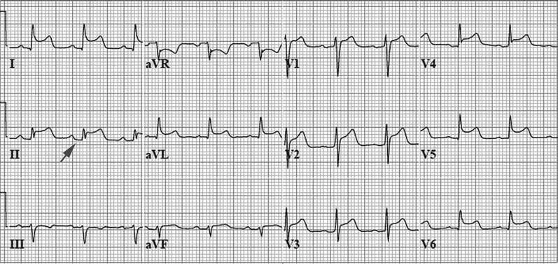 A 12-lead ECG tracing on standard grid paper displaying characteristic signs of acute pericarditis. The electrocardiogram demonstrates widespread, concave-upward ST-segment elevation across most leads (including I, II, aVL, aVF, and V2 through V6) with reciprocal changes in aVR. A distinct grey arrow in lead II points specifically to a downsloping depression of the PR segment, which is a hallmark finding of pericardial inflammation.