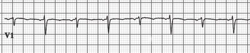 An ECG rhythm strip from lead V1 on grid paper demonstrating electrical alternans, a classic finding associated with pericardial effusion and cardiac tamponade. The tracing displays beat-to-beat variation in QRS amplitude, characterized by alternating taller and shorter QRS complexes as the heart swings back and forth within the fluid-filled pericardial sac.