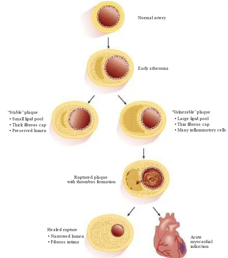 Flowchart diagram illustrating the stages of plaque progression in an artery. It tracks the evolution from a normal artery to an early atheroma, which can branch into a 'stable' plaque with a thick fibrous cap or a 'vulnerable' plaque with a thin cap and large lipid pool. The vulnerable path further shows a ruptured plaque with thrombus formation, leading either to a healed rupture with a narrowed lumen or an acute myocardial infarction.