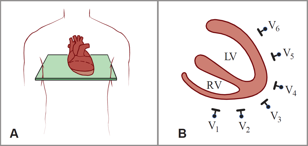 A two-panel diagram (A, B) illustrating the horizontal plane orientation of precordial ECG leads. Panel A shows a torso outline with a horizontal (transverse) plane intersecting the heart. Panel B shows a cross-sectional view of the heart depicting the right ventricle (RV) and left ventricle (LV) surrounded by chest leads V1 through V6 positioned in sequence from the right ventricle across the anterior wall to the lateral left ventricular wall. It shows leads V1 and V2 overlying the RV, lead V3 overlying the interventricular septum, lead V4 overlying the cardiac apex at the LV, leads V4 and V5 overlying the LV.