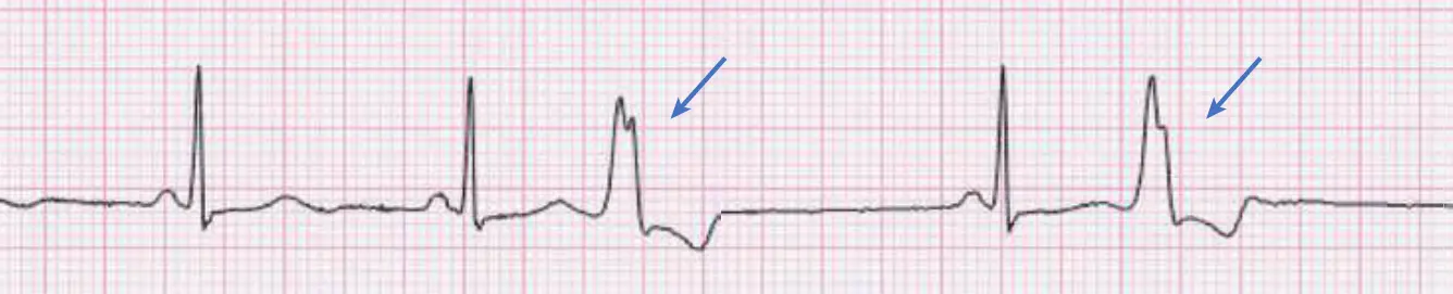 An ECG rhythm strip on pink grid paper displaying premature ventricular contractions (PVCs). The tracing begins with two normal sinus beats showing narrow QRS complexes preceded by P waves. The third beat occurs prematurely and is wide, bizarre, and notched, pointed to by a blue arrow, lacking a preceding P wave and followed by a compensatory pause. Normal sinus rhythm resumes with a single narrow beat before another wide, premature ventricular beat appears, indicated by a second blue arrow.