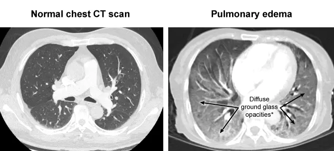 A side-by-side axial chest CT scan comparing a normal chest CT scan on the left with a CT scan showing pulmonary edema on the right. The pulmonary edema CT scan exhibits bilateral, diffuse ground-glass opacities indicated by arrows, with preservation of underlying bronchial and vascular markings, along with cardiomegaly.