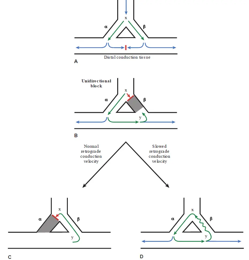A diagram with four panels (A, B, C, and D) illustrating the mechanism of a cardiac reentry circuit. Panel A shows a single vertical conduction pathway branching at a top junction (labeled "x") into two parallel pathways: alpha (left) and beta (right). Both pathways reconnect at a bottom horizontal pathway labeled "Distal conduction tissue". A blue arrow (electrical impulse) travels down the main pathway and splits into two green arrows that travel down both the alpha and beta pathways simultaneously. At the distal tissue, the impulses spread outward laterally (blue arrows) and inward toward each other, colliding and extinguishing, marked by a red vertical double line. Panel B introduces a "Unidirectional block". A gray shaded box with a red line sits at the top of the beta pathway near junction "x", stopping the downward impulse. The impulse (green arrow) only travels down the alpha pathway. Upon reaching the distal horizontal tissue, it spreads left (blue arrow) and also travels retrogradely (to the right and upward) into the bottom of the beta pathway at a junction labeled "y". Below Panel B, the flowchart splits into two possible outcomes based on conduction speed: Panel C, under the heading "Normal retrograde conduction velocity", shows the retrograde impulse (green arrow) traveling quickly up the beta pathway back to junction "x". However, a red line at the top of the alpha pathway (now shaded gray) indicates the alpha pathway tissue is still refractory. The impulse is blocked, and the signal terminates. Panel D, under the heading "Slowed retrograde conduction velocity", shows the retrograde impulse traveling up the beta pathway represented by a wavy green line, indicating delayed conduction. Because of this delay, by the time the impulse reaches junction "x", the alpha pathway has recovered from its refractory period. The green arrow successfully travels back down the alpha pathway, forming a continuous circular loop (the reentry circuit). At the bottom junction "y", blue arrows indicate the impulse spreading into the distal conduction tissue with every cycle of the loop.