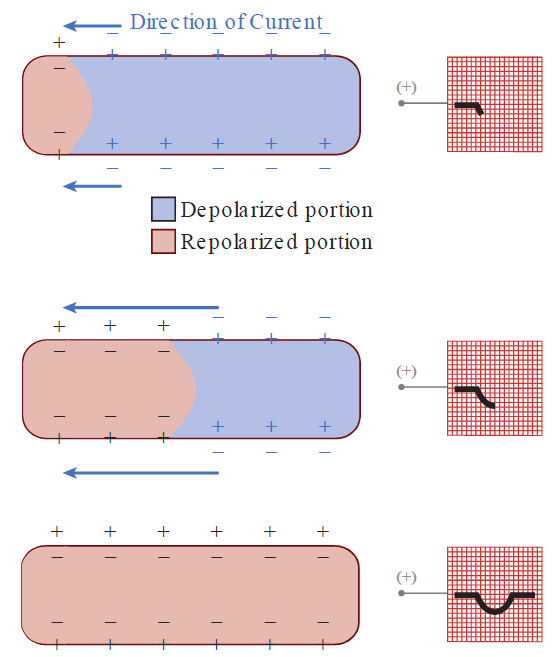A three-panel sequential diagram illustrating the electrical repolarization of a single cardiac muscle cell and its corresponding negative deflection on a voltmeter. Top panel: Repolarization begins at the left end of the cell (shaded pink, restored to positive outer and negative inner charges) while the remaining majority remains depolarized (shaded blue); blue arrows labeled "Direction of Current" point to the left away from the positive (+) electrode on the right, causing a downward deflection on the voltmeter. Middle panel: The wave of repolarization advances halfway across the cell moving left-to-right, enlarging the pink repolarized area and deepening the downward deflection on the voltmeter display. Bottom panel: The cell is completely repolarized (fully shaded pink with positive extracellular and negative intracellular charges), resulting in a full negative (downward) waveform that returns to baseline on the voltmeter trace.
