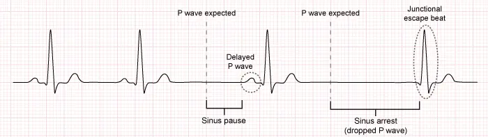 An ECG rhythm strip on standard grid paper illustrating sick sinus syndrome (SSS). The tracing begins on the left with four closely spaced, regular cardiac cycles, each consisting of a normal P wave, a narrow QRS complex, and a T wave. This is followed by a prolonged, flat isoelectric pause representing sinus arrest/pause. After the pause, a fifth QRS complex appears preceded by a delayed, lower-amplitude P wave (delayed sinus beat), followed by another long flat pause. The final beat on the far right occurs without a preceding normal sinus P wave, representing a junctional escape beat to resume cardiac rhythm.