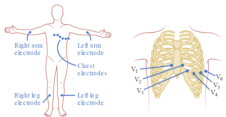 An anatomical illustration depicting standard 12-lead ECG electrode placement on the human body. Left side: A full-body outline shows the locations of four limb electrodes (Right arm electrode, Left arm electrode, Right leg electrode, and Left leg electrode) along with the cluster of Chest electrodes across the anterior thorax. Right side: A detailed view of the ribcage shows anatomical positions for precordial leads V1 through V6: V1 placed at the 4th intercostal space at the right sternal border, V2 at the 4th intercostal space at the left sternal border, V3 mid-way between V2 and V4, V4 at the 5th intercostal space in the midclavicular line, V5 in the 5th intercostal space at the anterior axillary line, and V6 in the 5th intercostal space at the midaxillary line.