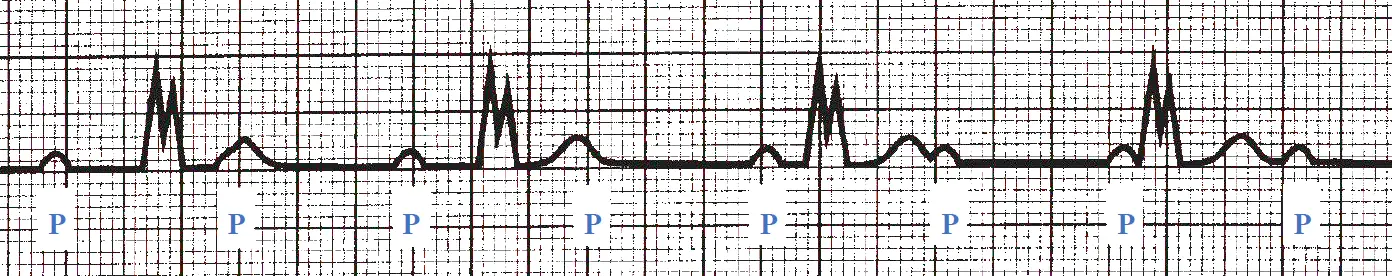 An ECG rhythm strip on standard grid paper displaying third-degree (complete) AV block with total AV dissociation. Eight regularly spaced P waves are each marked below with a blue letter "P", establishing a faster atrial rate independent of the ventricles. Four wide, notched QRS complexes (ventricular escape rhythm) appear at a slower, regular rate completely unrelated to the P waves. The second, fourth, sixth, and eighth P waves fall immediately after or are superimposed onto the preceding T waves, causing variable PR intervals throughout the tracing.