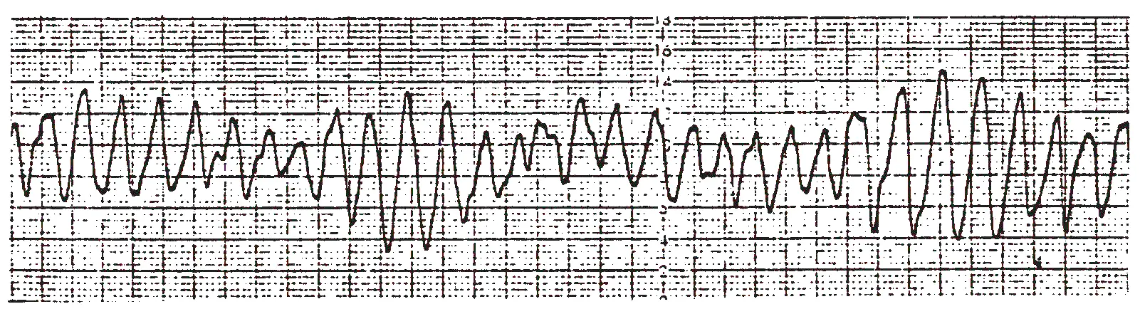 An ECG rhythm strip on standard grid paper displaying Torsades de Pointes. The tracing demonstrates a rapid polymorphic ventricular tachycardia where the amplitude and axis of the QRS complexes continuously twist and undulate around the central isoelectric line, shifting from tall upright peaks to downward deflections in a characteristic sinusoidal pattern.