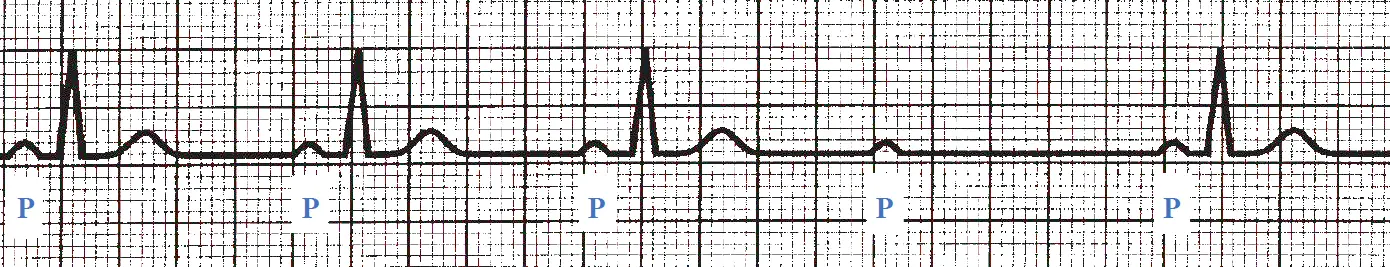 An ECG rhythm strip on standard grid paper displaying second-degree type II AV block. Five consecutive P waves are each labeled below with a blue letter "P". The first three P waves are conducted normally with constant PR intervals, each followed by a narrow QRS complex and a T wave. The fourth P wave fails to conduct (a dropped beat) and is followed only by a flat isoelectric line with no QRS complex or T wave. The fifth P wave conducts normally with the same constant PR interval as the preceding beats.
