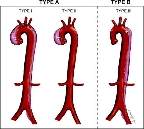 A anatomical diagram comparing Stanford and DeBakey classifications of aortic dissection across three illustrations of the aorta. The diagram is divided by a dashed vertical line into Stanford TYPE A on the left and Stanford TYPE B on the right. Under TYPE A, two variants are shown: TYPE I shows an intimal tear in the ascending aorta with the dissection flap (shaded in purple) extending distally through the arch, descending thoracic, and abdominal aorta; TYPE II shows the tear and dissection confined strictly to the ascending aorta. Under TYPE B, TYPE III shows the intimal tear originating distal to the left subclavian artery, with the dissection extending downward through the descending thoracic and abdominal aorta while sparing the ascending aorta and arch.