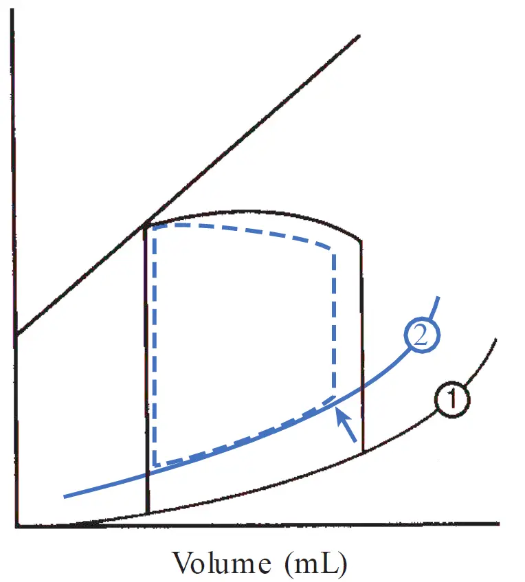 A ventricular pressure-volume loop comparing normal function (solid black line) with heart failure with preserved ejection fraction (HFpEF, blue dashed line). The diastolic compliance curve is shifted upward (from line 1 to line 2), indicating a stiffer ventricle with higher filling pressure for any given volume, resulting in a lower end-diastolic volume despite elevated diastolic pressures.